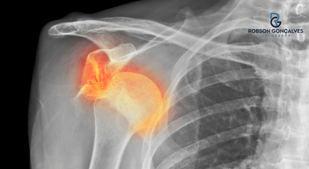 Luxação acromioclavicular (CID10 S.43.1): quais benefícios do INSS pode receber
