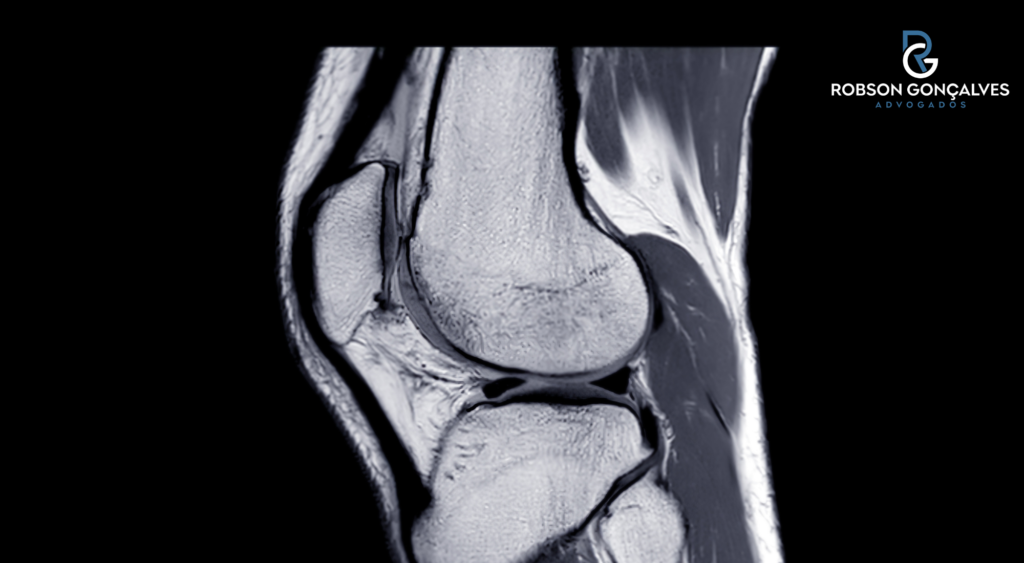 Auxílio-acidente pela lesão do ligamento cruzado anterior